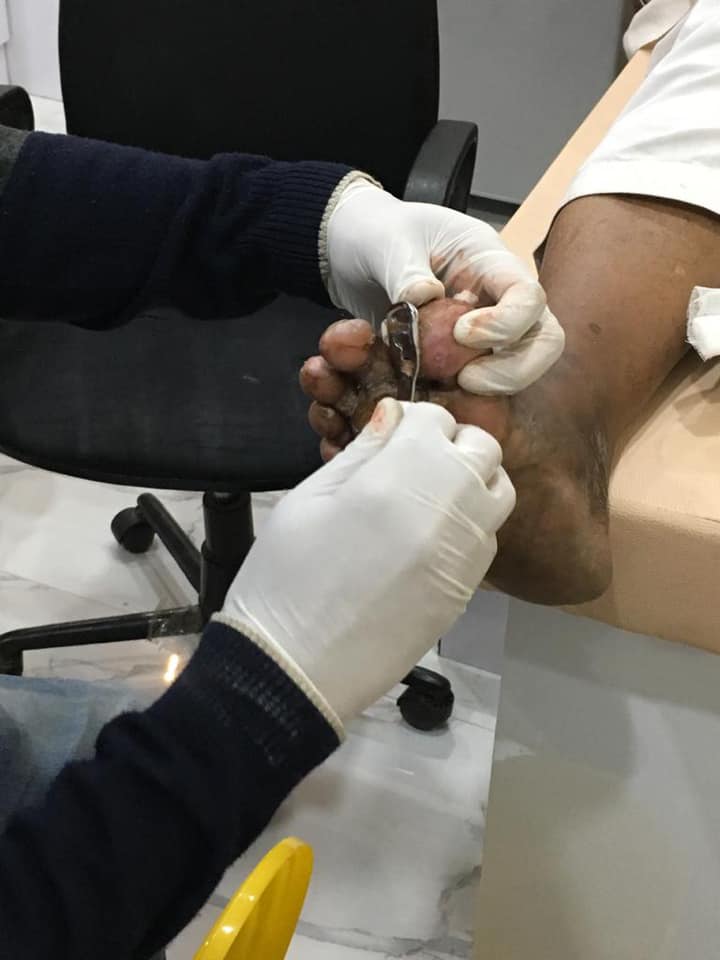 Diabetic Foot Care Treatment