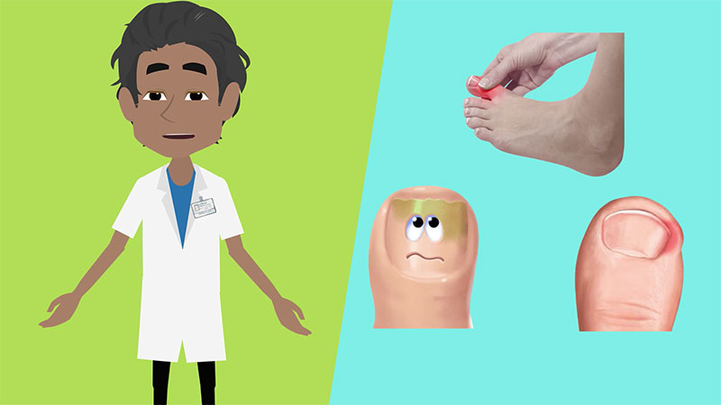 Ingrown Toenail Infection