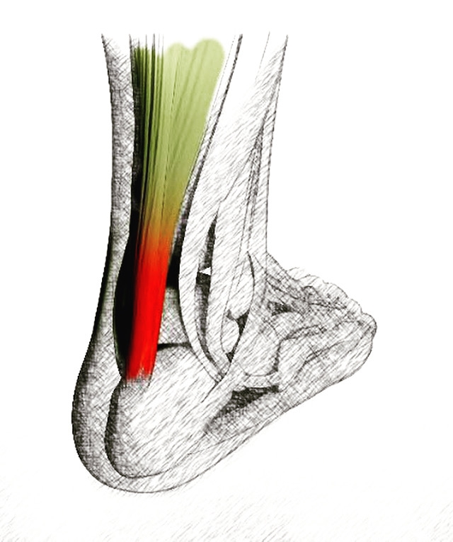 Achilles Tendinitis Symptoms