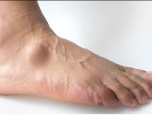 Foot Pain Treatment