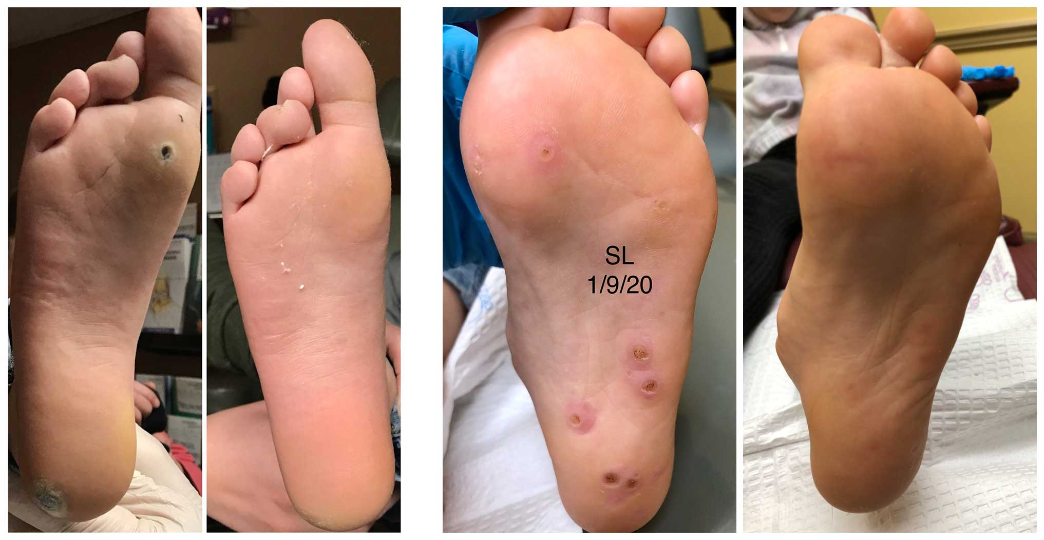wart on foot cut out