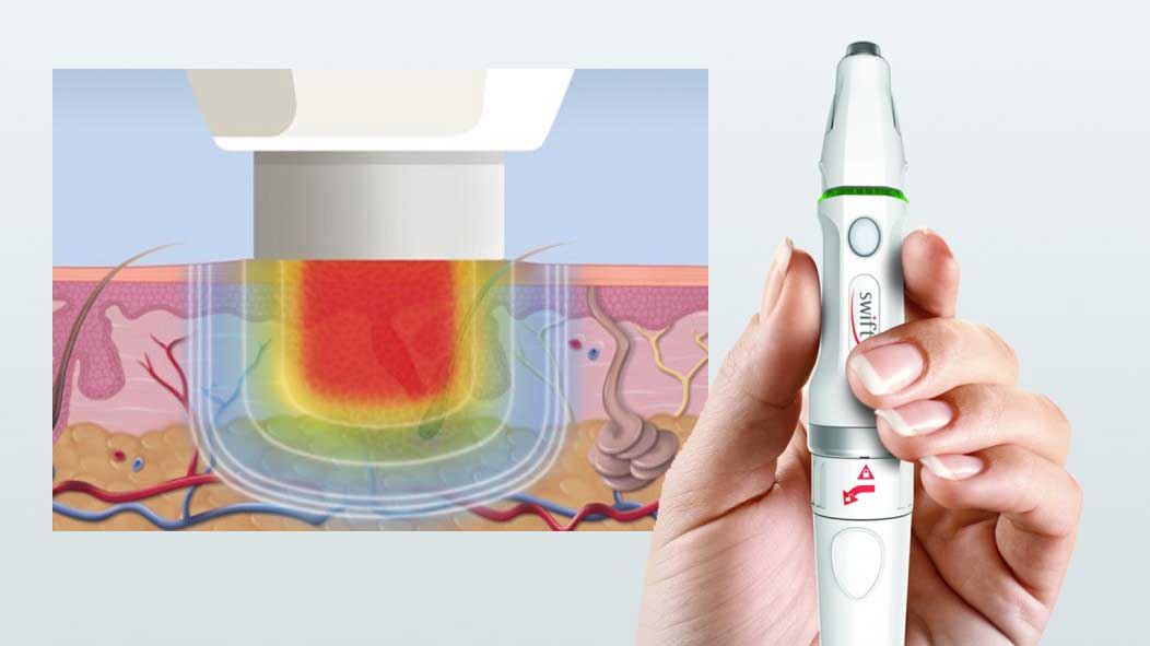swift-microwave-energy-applicator